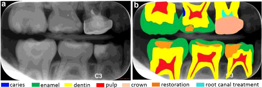 A benchmark for comparison of dental radiography analysis algorithms