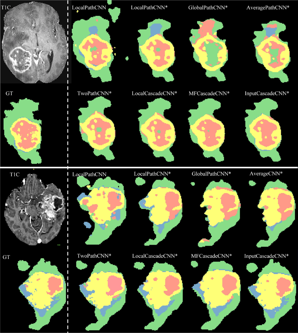 Brain tumor segmentation with Deep Neural Networks